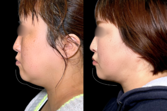 脂肪吸引プレミアム（頬・顎下）＋糸リフト（グランリフト）＋エラボトックス