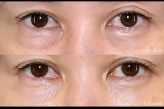 切らない目の下のクマ取り＋ヒアルロン酸（目の下）＋ボトックス注射（目頭・目の下・目尻）