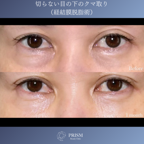 切らない目の下のクマ取り+ヒアルロン酸(目の下)+ボトックス注射(目頭・目の下・目尻) 切らない目の下のクマ取り+ヒアルロン酸(目の下)+ボトックス注射(目頭・目の下・目尻)