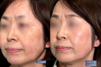 美人レーザー(MIINレーザー) 【トーニング】【スポット シミ取り放題】