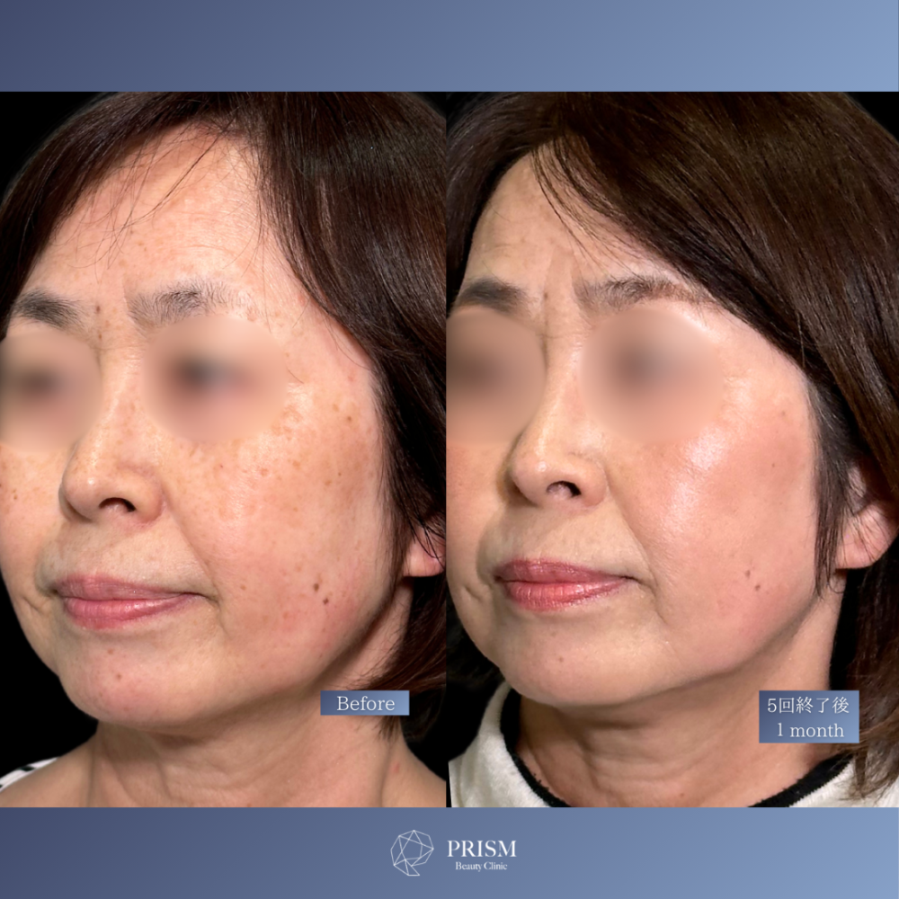 美人レーザー(MIINレーザー) 【トーニング】【スポット シミ取り放題】