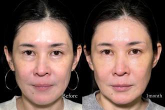 切らない目の下のクマ取り＋ヒアルロン酸（目の下）＋ボトックス注射（目頭・目の下・目尻）