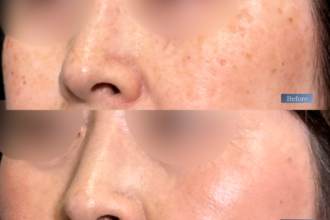 美人レーザー(MIINレーザー) 【トーニング】【スポット シミ取り放題】