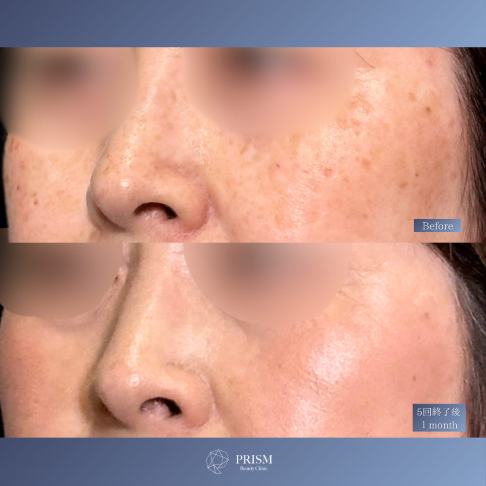 美人レーザー(MIINレーザー) 【トーニング】【スポット シミ取り放題】