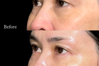 切らない目の下のクマ取り＋ヒアルロン酸（目の下）＋ボトックス注射（目頭・目の下・目尻）