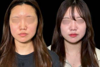 ほくろ除去　RFナイフによるくり抜き法