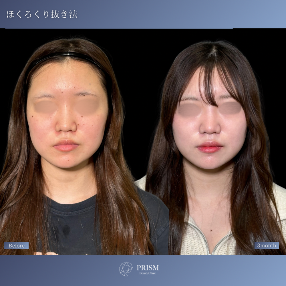 ほくろ除去　RFナイフによるくり抜き法