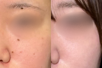 ほくろ除去　RFナイフによるくり抜き法