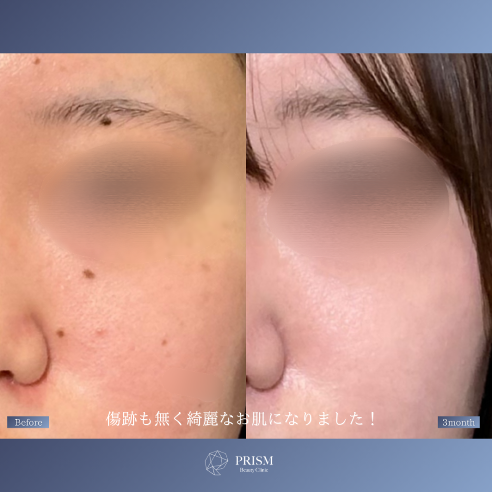 ほくろ除去　RFナイフによるくり抜き法