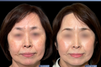 美人レーザー(MIINレーザー) 【トーニング】【スポット シミ取り放題】