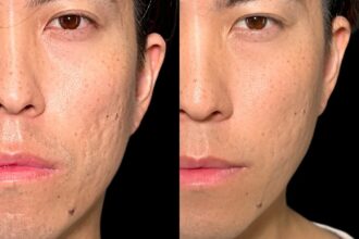 サブシジョン＋ヒアルロン酸注射