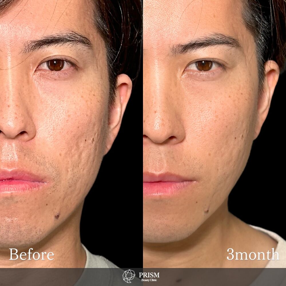 サブシジョン＋ヒアルロン酸注射