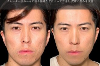 サブシジョン＋ヒアルロン酸注射