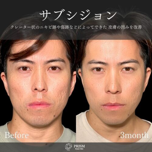 サブシジョン+ヒアルロン酸注射 サブシジョン+ヒアルロン酸注射