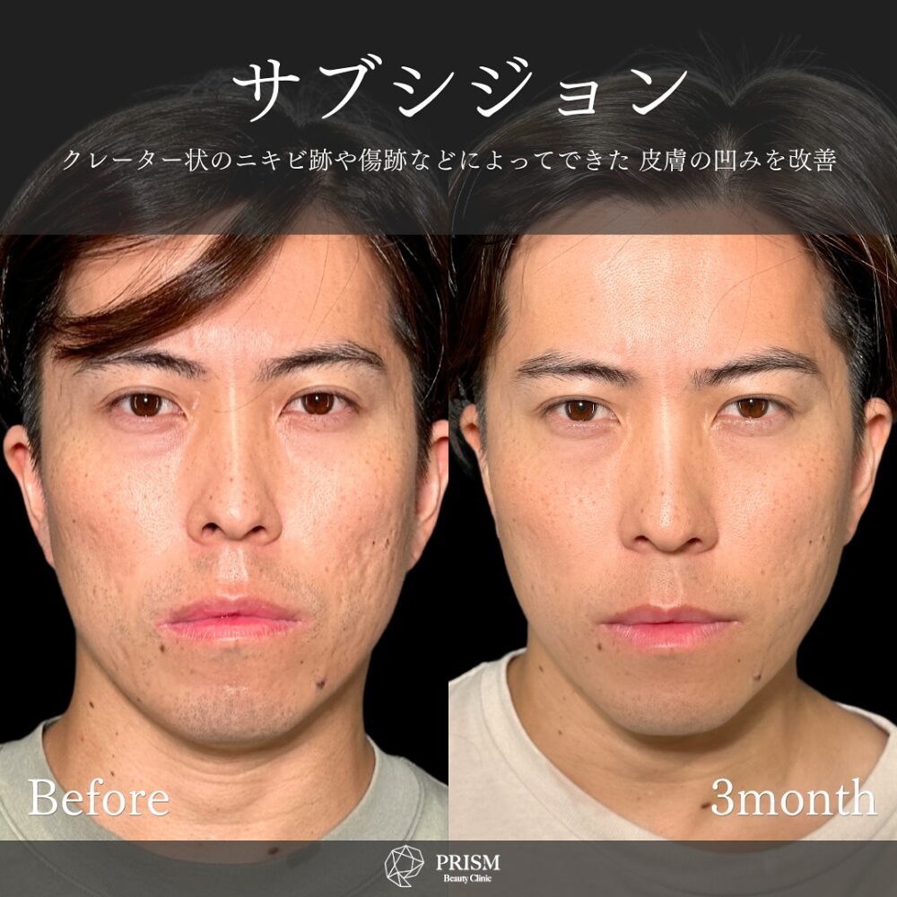 サブシジョン＋ヒアルロン酸注射