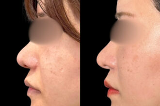 鼻孔縁挙上 鼻孔縁挙上