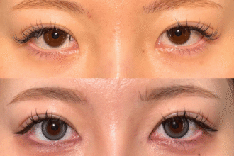 目頭切開 目頭切開