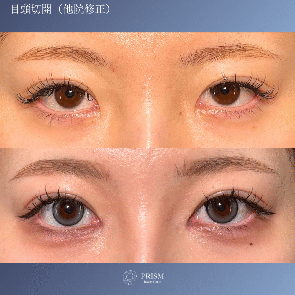 目頭切開 目頭切開