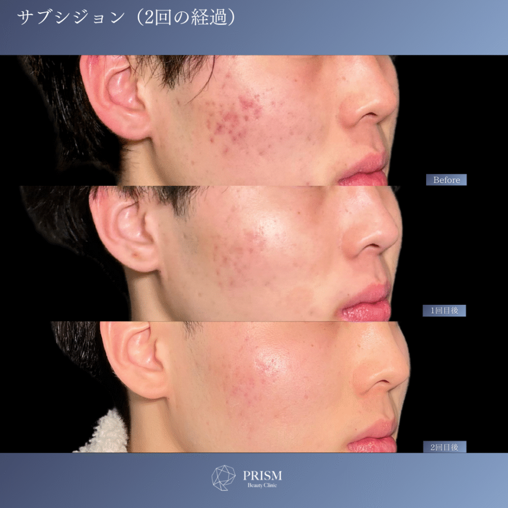 サブシジョン＋ヒアルロン酸注射＋ジュベルック注射