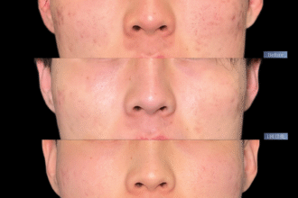 サブシジョン＋ヒアルロン酸注射＋ジュベルック注射