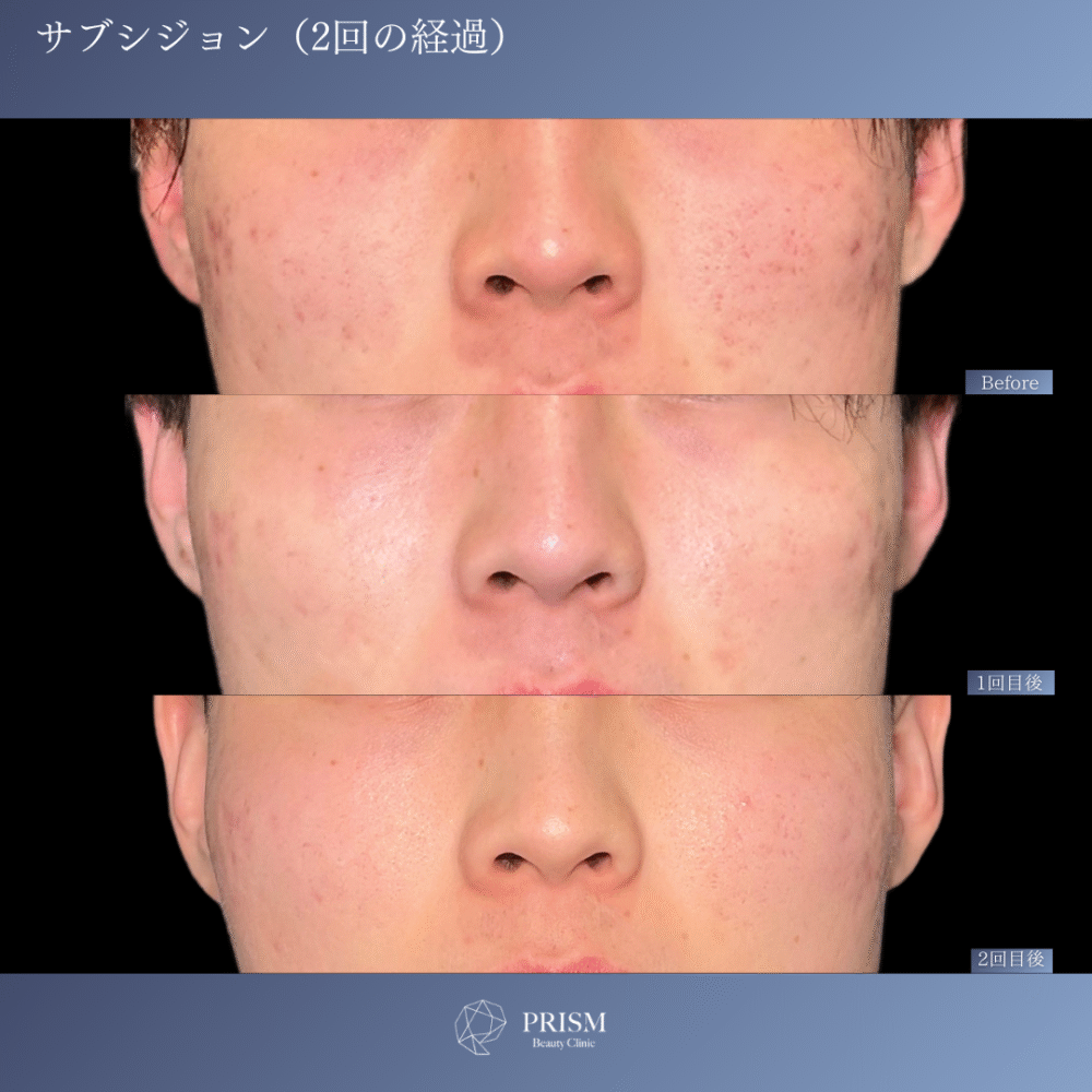 サブシジョン＋ヒアルロン酸注射＋ジュベルック注射