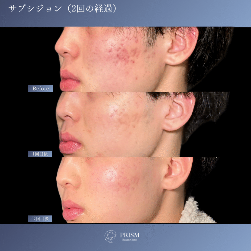 サブシジョン＋ヒアルロン酸注射＋ジュベルック注射