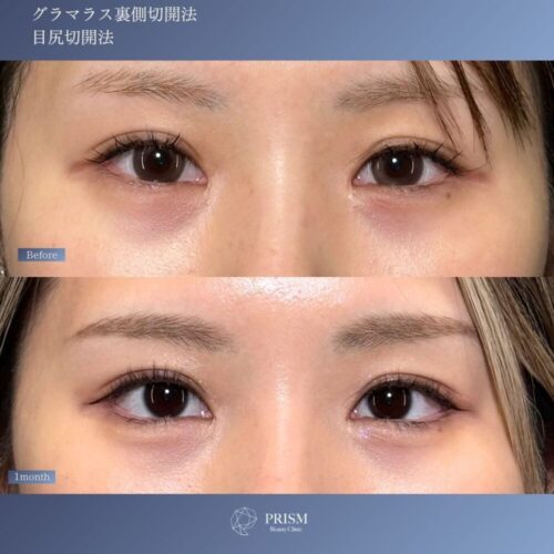 目尻切開+たれ目形成(グラマラスライン) 裏側切開 パーフェクト 目尻切開+たれ目形成(グラマラスライン) 裏側切開 パーフェクト
