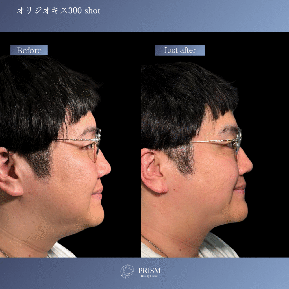 小顔リフトアップ美容器 楽天市場】EMS美顔器 顔 たるみ しわ 顔 ほうれい線 リフト