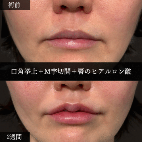 口角挙上＋M字リップ＋唇のヒアルロン酸注射