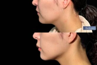 エルサ脂肪吸引プレミアム(頬・顎下)+メーラーファット除去+ジョールファット除去+糸リフト(ウルトラソフト) エルサ脂肪吸引プレミアム(頬・顎下)+メーラーファット除去+ジョールファット除去+糸リフト(ウルトラソフト)