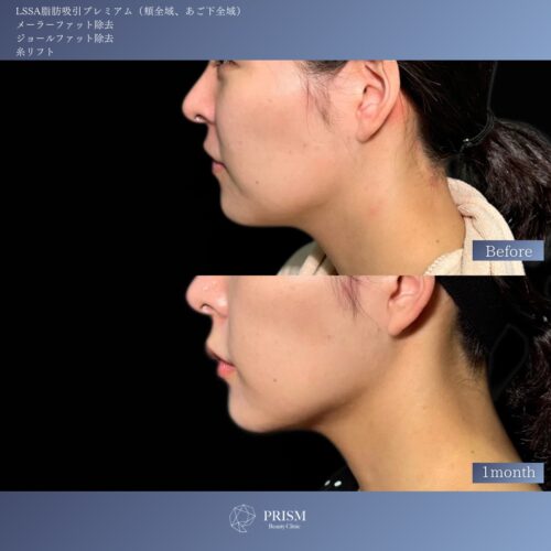 エルサ脂肪吸引プレミアム(頬・顎下)+メーラーファット除去+ジョールファット除去+糸リフト(ウルトラソフト) エルサ脂肪吸引プレミアム(頬・顎下)+メーラーファット除去+ジョールファット除去+糸リフト(ウルトラソフト)