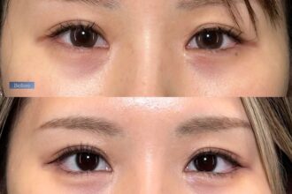 目尻切開+たれ目形成(グラマラスライン) 裏側切開 パーフェクト 目尻切開+たれ目形成(グラマラスライン) 裏側切開 パーフェクト