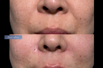 ジュブゼン（ほうれい線）