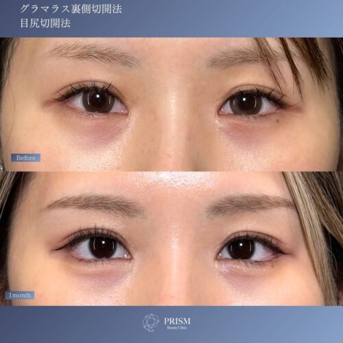 目尻切開＋たれ目形成(グラマラスライン) 裏側切開 パーフェクト