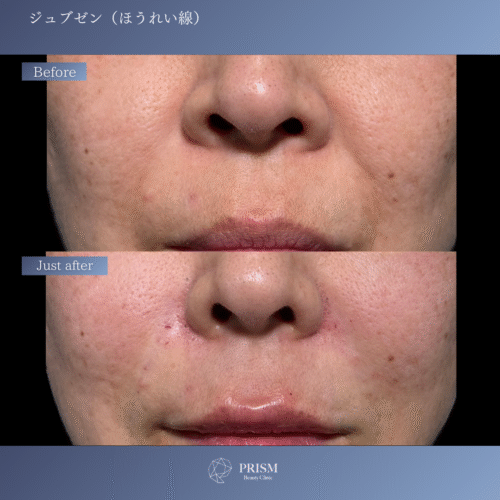 ジュブゼン(ほうれい線) ジュブゼン(ほうれい線)