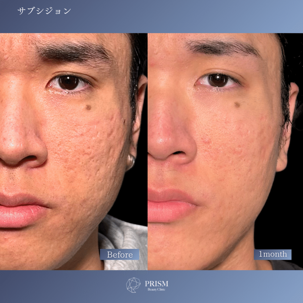 サブシジョン＋ヒアルロン酸注射