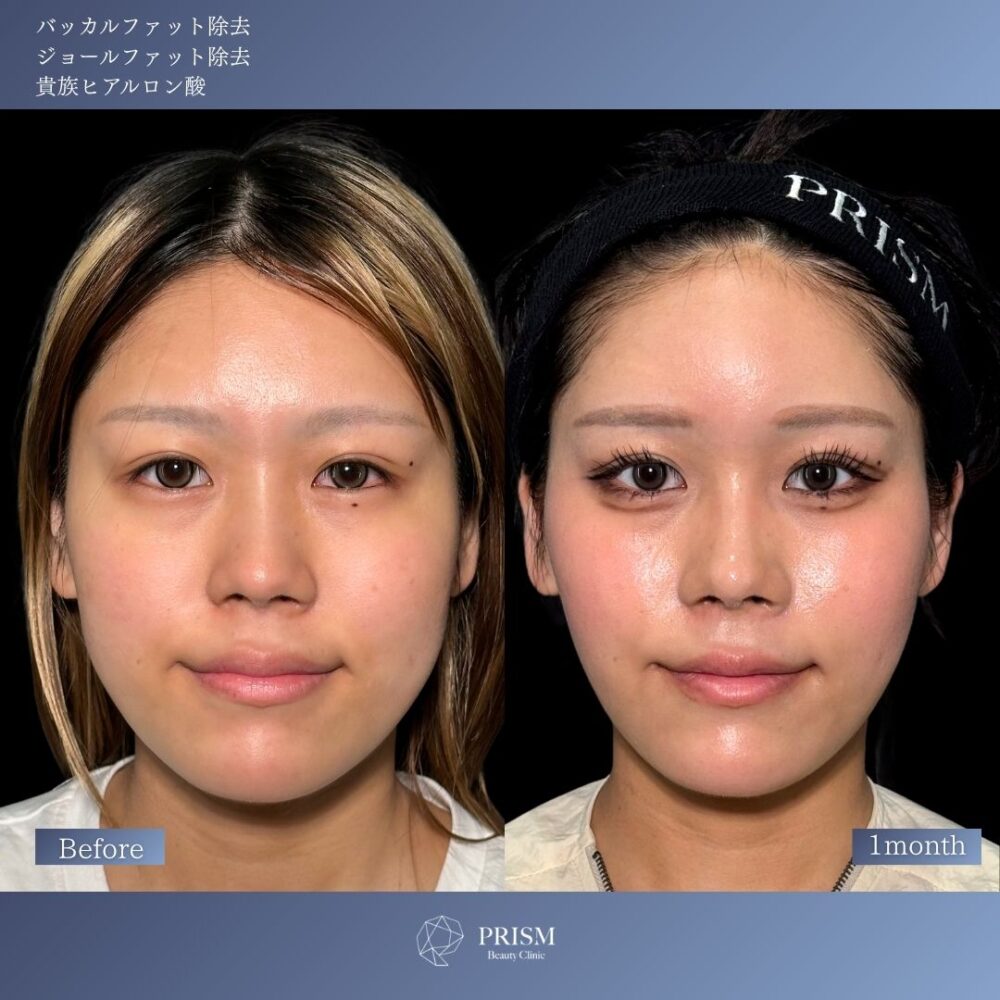 バッカルファット除去+ジョールファット除去+ヒアルロン酸注射(貴族) バッカルファット除去+ジョールファット除去+ヒアルロン酸注射(貴族)