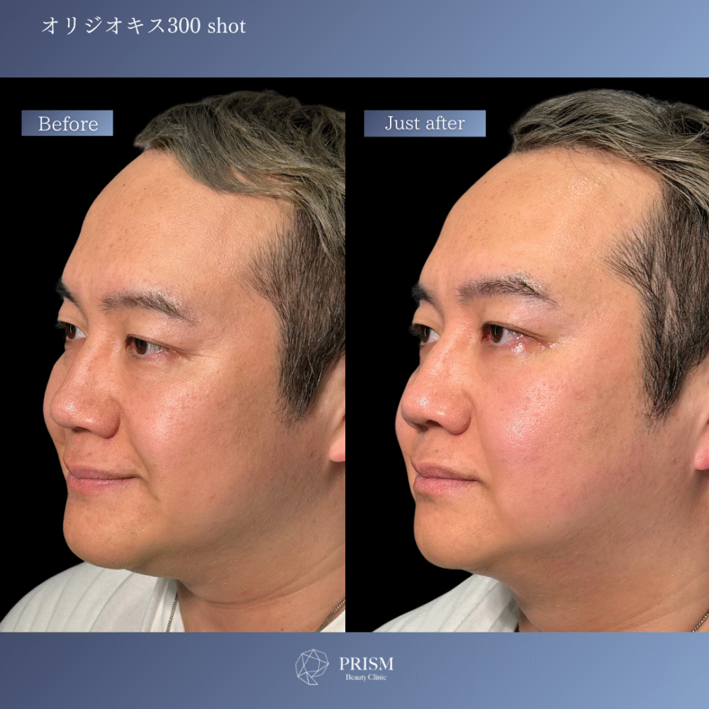 オリジオKISS（RF600ショット＋HIFU400ショット）