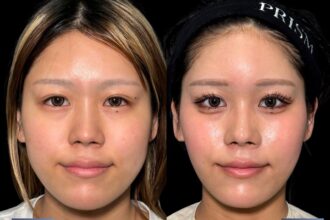 バッカルファット除去＋ジョールファット除去＋ヒアルロン酸注射（貴族）