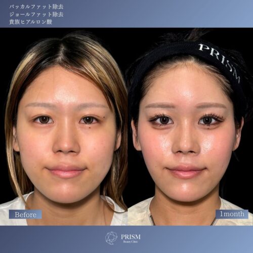 バッカルファット除去＋ジョールファット除去＋ヒアルロン酸注射（貴族）