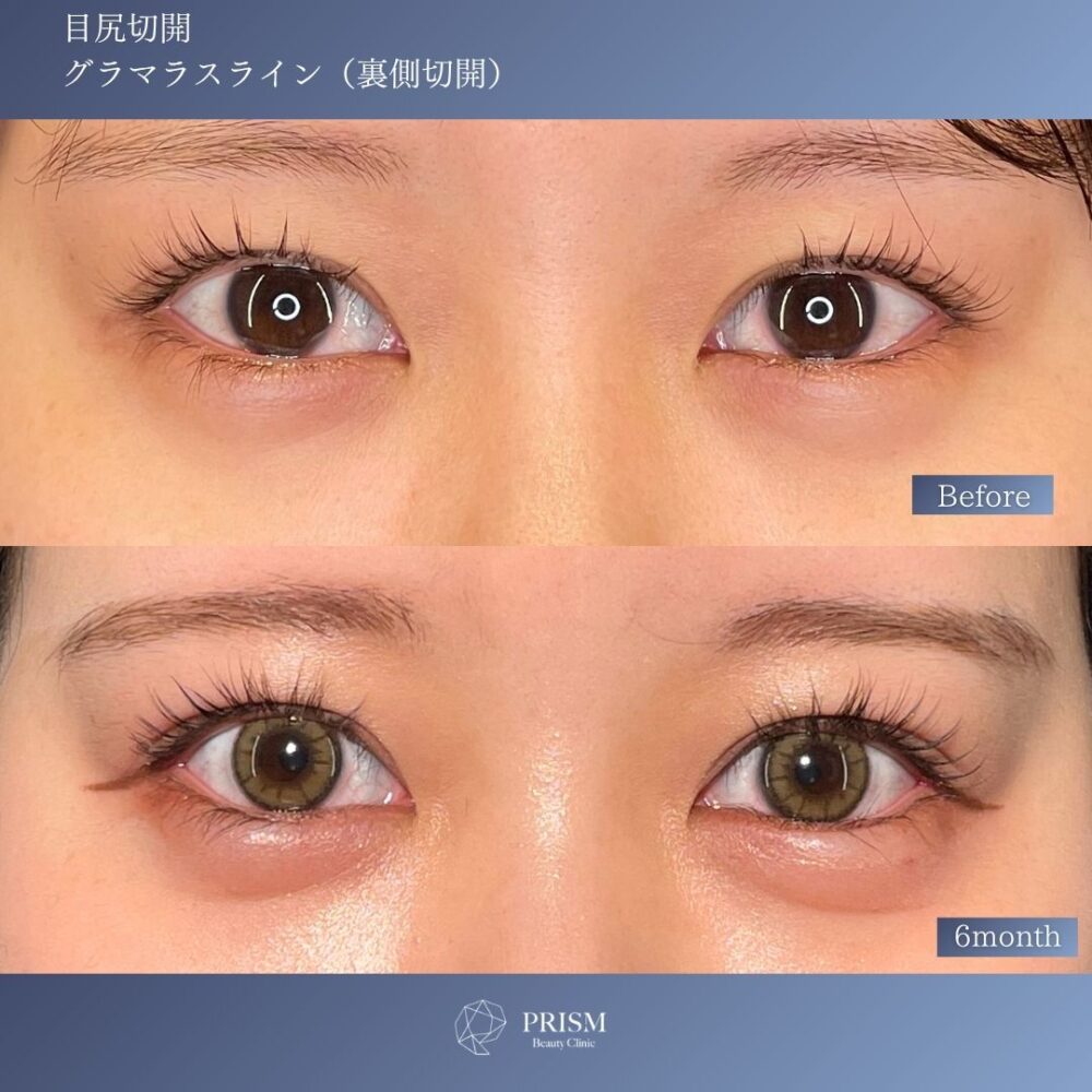 目尻切開＋たれ目形成(グラマラスライン) 裏側切開 パーフェクト