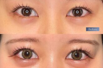 目尻切開＋たれ目形成(グラマラスライン) 裏側切開 パーフェクト