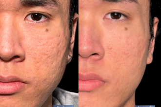 サブシジョン＋ヒアルロン酸注射