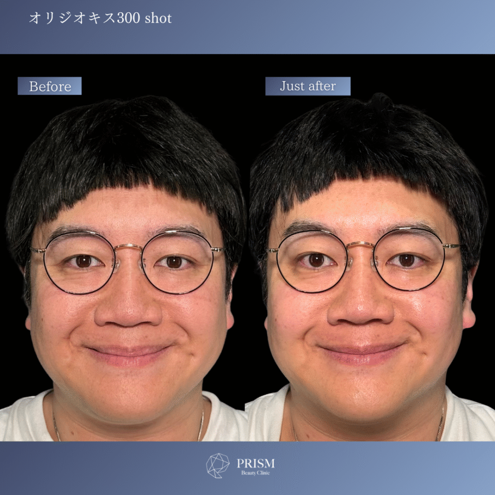 オリジオKISS（RF600ショット＋HIFU400ショット）