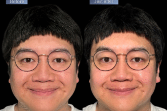 オリジオKISS（RF600ショット＋HIFU400ショット）