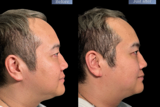 オリジオKISS（RF600ショット＋HIFU400ショット）