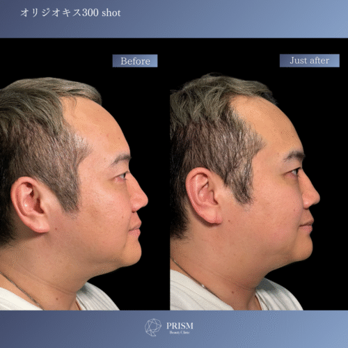 オリジオKISS（RF600ショット＋HIFU400ショット）