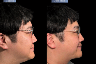 オリジオKISS（RF600ショット＋HIFU400ショット）