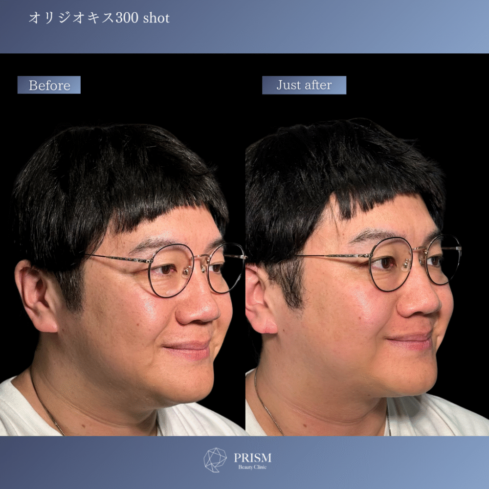 オリジオKISS（RF600ショット＋HIFU400ショット）