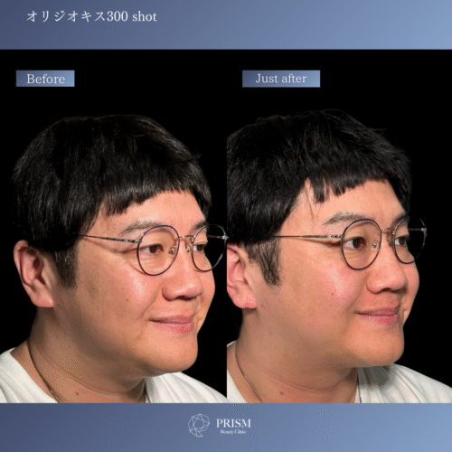 オリジオKISS（RF600ショット＋HIFU400ショット）